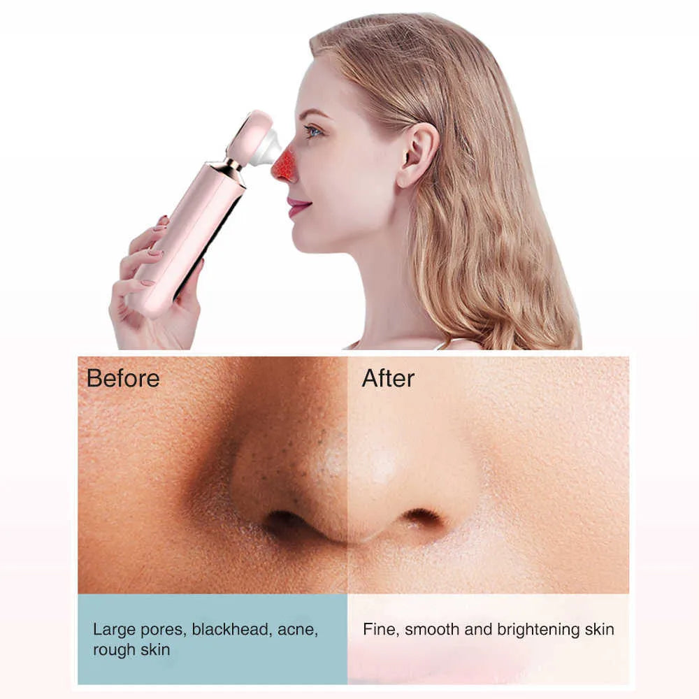 SANQUIX™ Blackhead Suction Machine